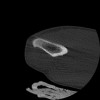 SPORK, NICO - 22.03.1976 - 02.08.2022 - CT obere Extremität - 17:51:17